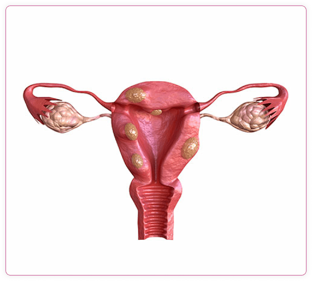 Urinary infections